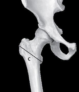 Breuk in het brede gedeelte van het dijbeen